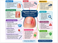 Ingrown Toenail poster anatomical illustration detail for podiatry clinics