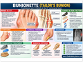 Bunionette educational poster covering symptoms, treatment, and prevention
