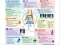 Ankle Arthritis poster anatomical illustration detail for podiatry clinics
