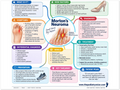 Morton's Neuroma poster anatomical illustration detail for podiatry clinics