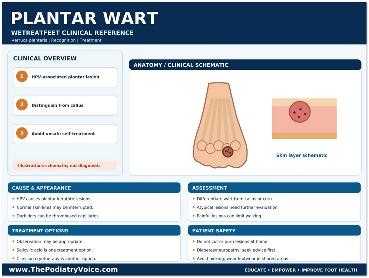 Plantar Wart Clinical Reference educational poster covering symptoms, treatment, and prevention