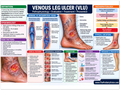 Venous Leg Ulcer poster anatomical illustration detail for podiatry clinics