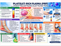 Platelet-Rich Plasma poster anatomical illustration detail for podiatry clinics