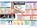 Pes Cavus educational poster covering symptoms, treatment, and prevention