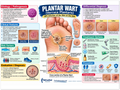 Plantar Wart poster anatomical illustration detail for podiatry clinics