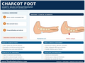 Charcot Foot poster anatomical illustration detail for podiatry clinics