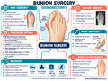 Bunion surgery (bunionectomy) patient education poster infographic for podiatry clinics