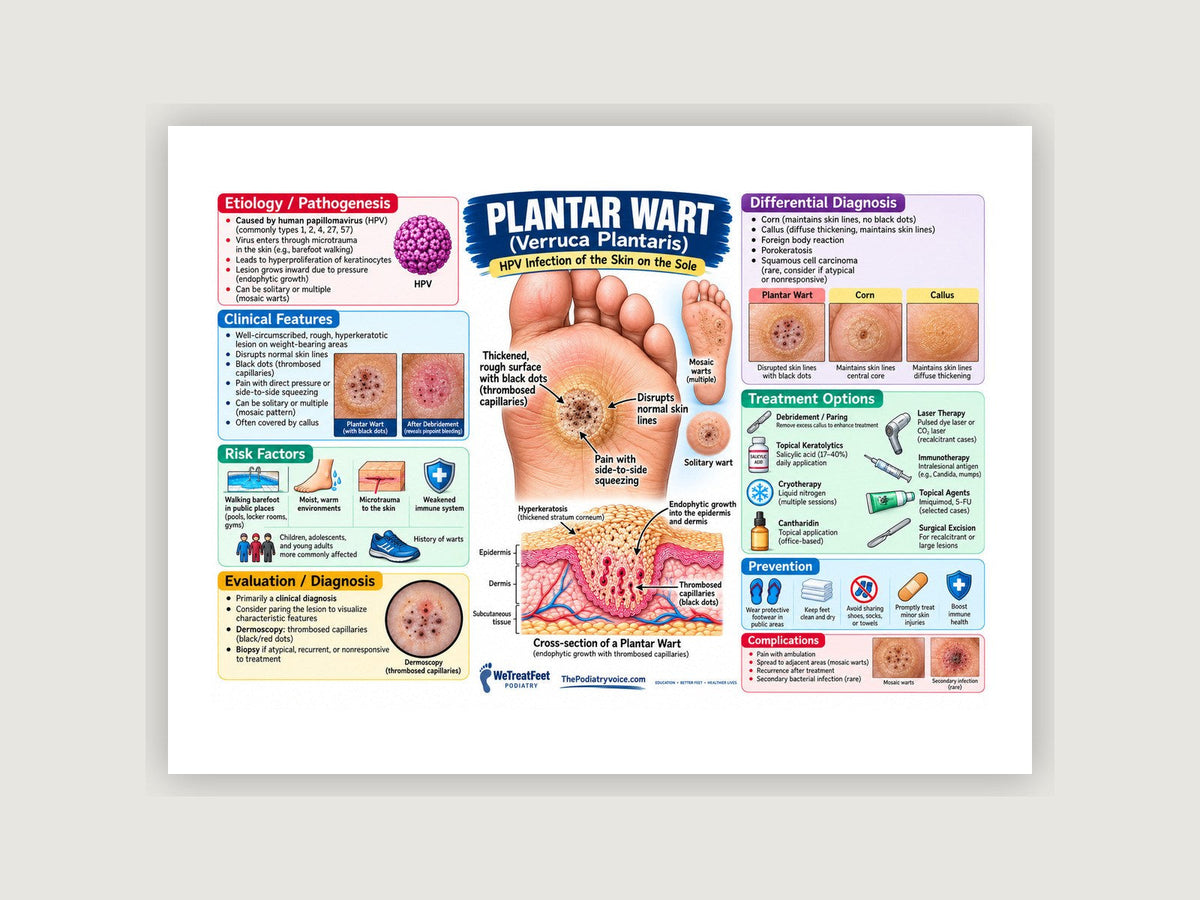 Plantar Wart patient education poster displayed on a podiatry exam room wall